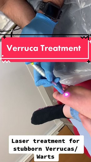 Advanced Laser Treatment for Stubborn Verrucas/Warts