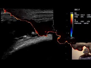 Quadriceps Tendon Rupture MSK Ultrasound