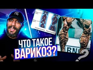 ВАРИКОЗ - ПРИЧИНЫ, ЛЕЧЕНИЕ, ПРОФИЛАКТИКА