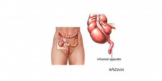 Appendicitis Management and Nursing Care Plan
