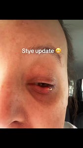 😱 You won't believe what came out of this one... #pimplepop #satisfying | Pimple Popping