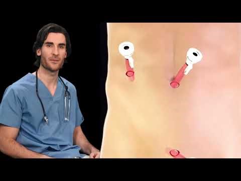 Apendicectomía laparoscópica: Cómo se realiza la cirugía del apéndice (Animación 3D)