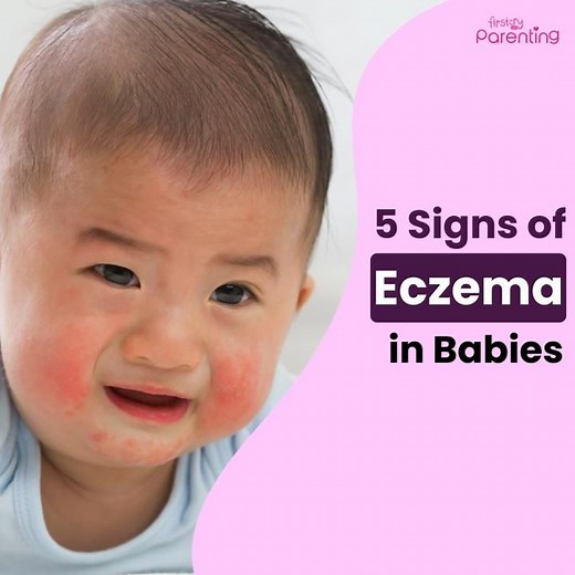 5 Early Signs Of Eczema In Babies | Baby Eczema