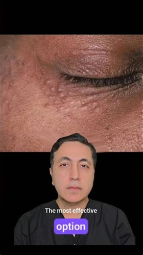 Under-Eye Syringomas Explained in 60 Seconds | Causes & Treatment