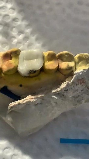 Onlay Restoration and PFM Crown Placement Procedure