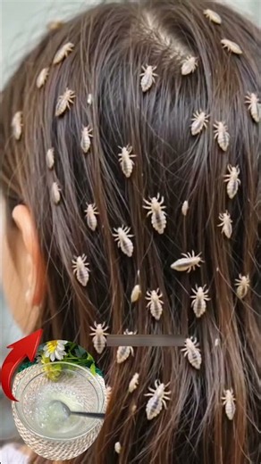 A simple hair care step for managing lice and keeping the scalp fresh ✨