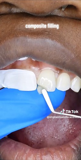 Today we did a simple composite filling. Simple yet very satisfying. I'll use dentine layers next time for more opacity. #directveneers #masking #veneersjourney #veneersjourney #veneers #zirconia #implants #bracesoff #cosmeticdentist #dentist