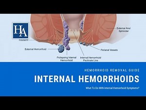 First Degree Hemorrhoids Treatment Guide - What Are 1st Degree Hemorrhoids?