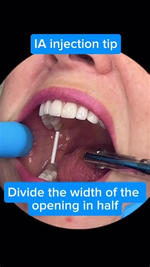 Dentistry My World 🌍 on Instagram: "Repost from @shelley_the_hygienist 👏 Mastering the IA ensures reliable anesthesia across the mandibular arch while minimizing patient discomfort and complications. ✅ Key Landmarks: • Coronoid notch – deepest concavity on the anterior border of the ramus. • Pterygomandibular raphe – vertical soft-tissue guide for posterior placement. • Mandibular occlusal plane – maintain a height of insertion 6–10 mm above it. ✅ Insertion Point: Medial side of 