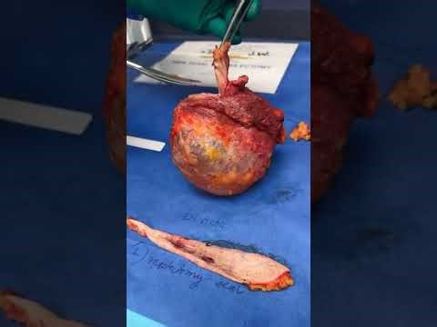 Dr. Khan Performs A Procedure On a Patient with Bilateral Breast Cancer