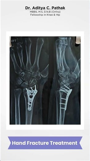 Hand Fracture Treatment | Dr. Aditya Pathak