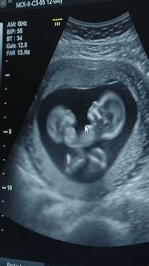 Incredible Ultrasound: Counting All 8 Heartbeats