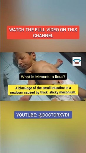 Inside Meconium Ileus: What Happens Before the First Cry Now!