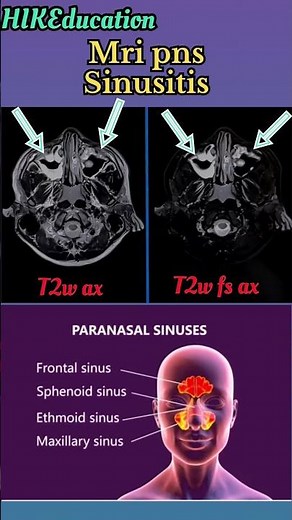Sinusitis / mri pns / rhinosinusitis / paranasal sinus / pns / #sinusitis / #pns #viral