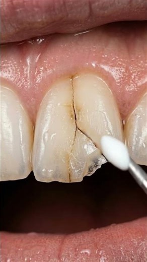 Starts with the exact search phrases people use (“Cracked Front Tooth Repair “Chipped Front Tooth”)