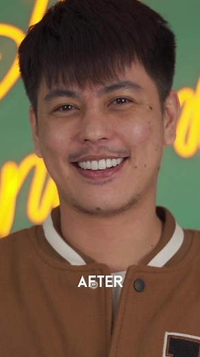 Upgrade Your Smile with Emax Veneers by Keith Talens