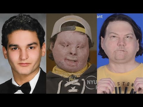 'New chance at life': Man gets face, hands in rare surgery