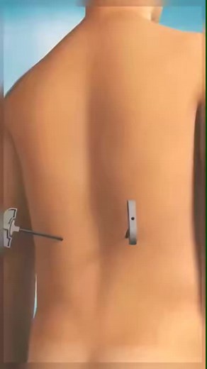 bone repair #vira#health #surgery