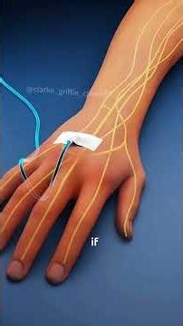 How Chemotherapy is Done? (3D Animation) #how #chemotherapy #cancer #skin #3danimation