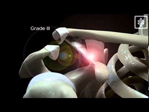 ACJ dislocation mechanism Shoulderdoc
