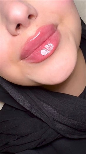 Dr. Katrin 📍Cairo, Lips/face fillers, Botox, Skincare | No need to make duck lips if you don’t want😉 Here I made 0,7ml of Stylage filler and we got very natural and so sexy result 😍 Don’t... | Instagram