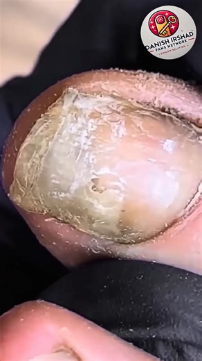 Diabetic feet: simple methods to prevent problems 🎀 #HealthyHabits #FootSupport #SeniorHealth | Danish irshad fans