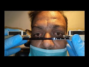 Hertel Exophthalmometry