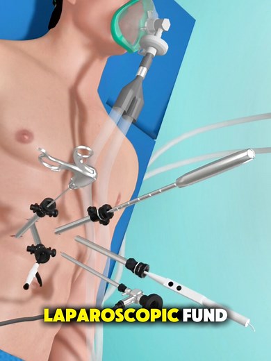 How Laparoscopic Fundoplication is Done? (3D Animation) #how #laparoscopy #pain #acid #3danimation