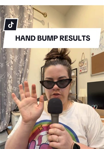 On my paperwork the biopsy officially says it was a Dermal Nevus with an Associated Epidermoid Cyst on Ulnar Right Palm. Recovery was super easy all I had to do was wash it with soap and water twice a day, put aquaphor on it and cover it with a bandage until it started to scab up. It’s pretty much all scabbed up and gone now 💖 It’s so weird not having it anymore! Sometimes I can still feel its ghost 😂 but I’m SO glad I got this done, it was bothering me for so long! #dermatologist #cyst #mole 