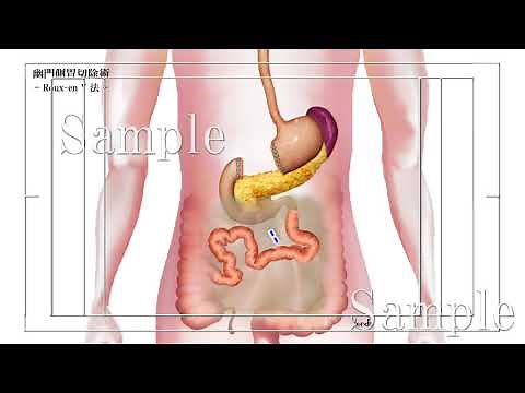 幽門側胃切除 Roux-en-Y法 再建イメージ