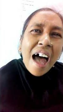 Motor Neuron Disease (MND) with Pseudo bulbar Palsy