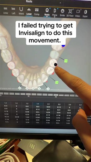 Overcoming Challenges with Invisalign Treatments