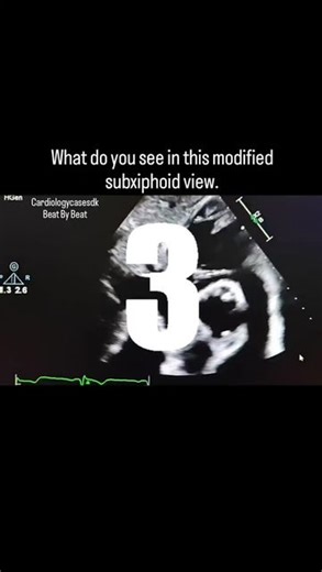 Simon Kristiansen on Instagram: "You can get a lot of information if you have a good subxiphoid view. Sometimes it can be difficult to get a good parasternal and apical scan in patients with COPD and persons with breast implants so remember the subxiphoid view 🙌🏻💪🏻🫀💯. #cardiologycasesdk #echocardiography #echocardiography #transthoracicechocardiogram #echocardiographer #ultrasounds #ultrasound #ultralyd #cardiac #cardiología #cardiacnurse #cardiology #cardiologyfellow #medical #medico #med