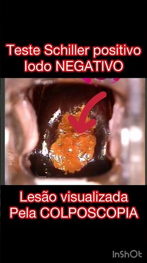 Teste Schiller POSITIVO | Iodo NEGATIVO-Pesquisa de lesões pelo HPV