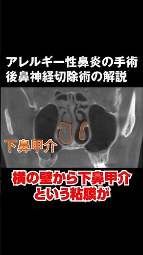 アレルギー性鼻炎の手術「後鼻神経切除術」とは？【CT写真で耳鼻科医が解説】