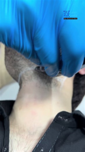 Effective Candle Laser Hair Removal Techniques