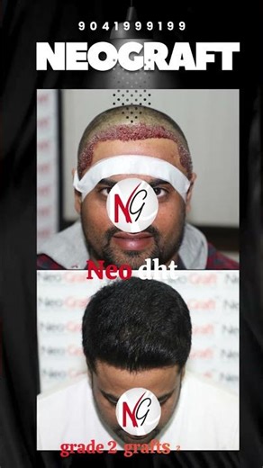Grade 2 Traction Baldness Treated with NeoDHT® | Hair Transplant Results | NeoGraft India