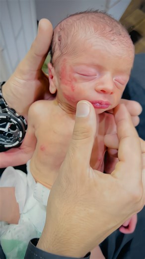 Premature Baby Born at 32 Weeks #baby #nicubaby