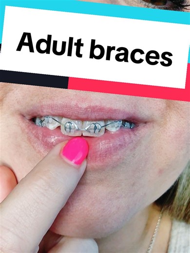 Adult Braces Journey: First Adjustment Experience