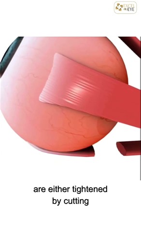 How Squint Eye Surgery Works | Eye Muscle Correction Explained | Dr Anisha Gupta, Delhi
