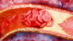 Cholesterrol or Atherosclerotic Plaque in blood vessels, Blocked vessel stroke, Thickened Arteries and Veins, Coronary, fat buildup clogging, Atherosclerosis or atheromatous Hyperlipidemia, 3d render