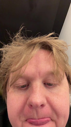 Receding Hairline Made the Cut: Lewis Capaldi Vibes
