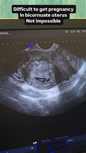 Pregnancy in left cornua of bicornuate uterus