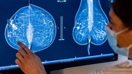 ‘Revolutionary’ AI-powered mammograms can predict breast cancer risk