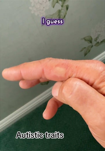 #fingerbiting #dermatophagia #autismingirls #autisminwomen #sensoryprocessing #cptsdsurvivor #chronicpainwarrior #healinginprogress #innerchildhealingjourney