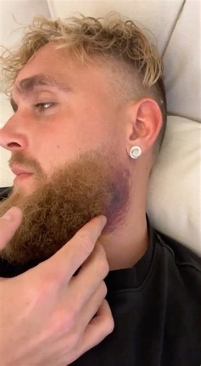 Jake Paul jaw update after Fight 🤣