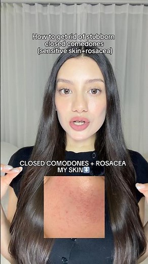 How to get rid of closed comodones when you have sensitive skin✨
