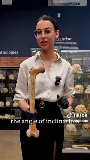 Coxa valga vs coxa vara: femur angle explained
