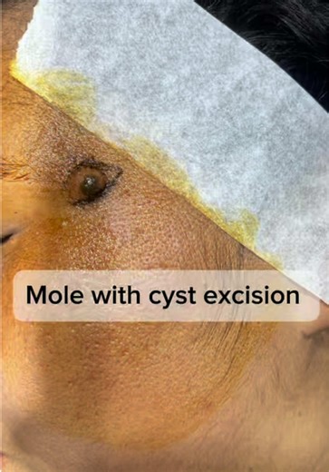 Mole with cyst — excision performed. Clean margins and controlled removal. #dermatology #skintok #medicalreels #aestheticmedicine #skinexcision