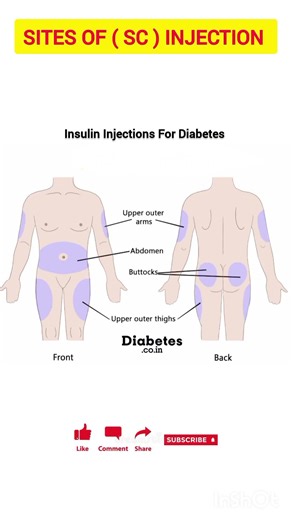 Sites Of SC Injection l SC Injection ke sites l#medical #medicosstuff #ytshortsviral #nursing#nurse
